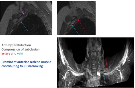 cervical compression test thoracic outlet syndrome|thoracic outlet syndrome mri results.